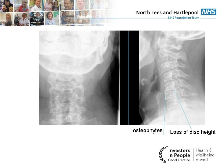 osteophytes Loss of disc height 