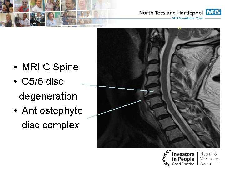  • MRI C Spine • C 5/6 disc degeneration • Ant ostephyte disc