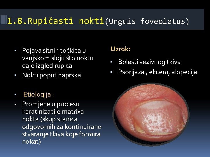 1. 8. Rupičasti nokti(Unguis foveolatus) ▪ Pojava sitnih točkica u vanjskom sloju što noktu