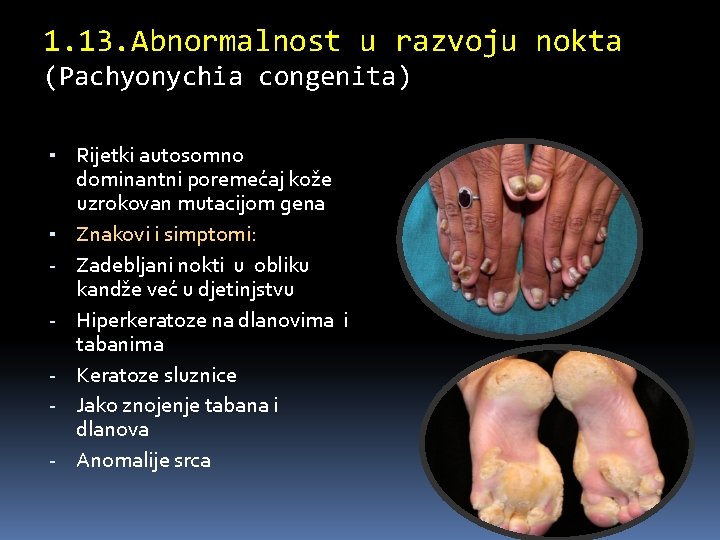 1. 13. Abnormalnost u razvoju nokta (Pachyonychia congenita) ▪ Rijetki autosomno ▪ - dominantni