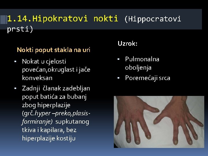 1. 14. Hipokratovi nokti (Hippocratovi prsti) Nokti poput stakla na uri ▪ Nokat u