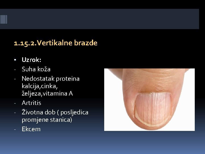 1. 15. 2. Vertikalne brazde ▪ Uzrok: - Suha koža - Nedostatak proteina kalcija,