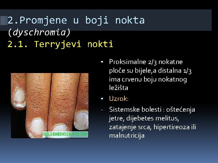 2. Promjene u boji nokta (dyschromia) 2. 1. Terryjevi nokti ▪ Proksimalne 2/3 nokatne