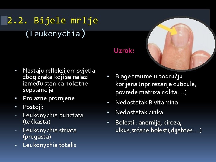2. 2. Bijele mrlje (Leukonychia) Uzrok: ▪ Nastaju refleksijom svjetla ▪ ▪ - zbog