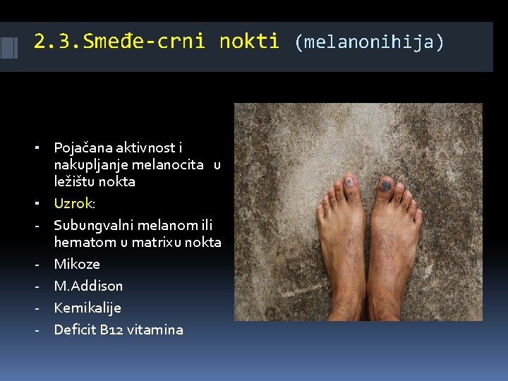 2. 3. Smeđe-crni nokti (melanonihija) ▪ Pojačana aktivnost i ▪ - nakupljanje melanocita u