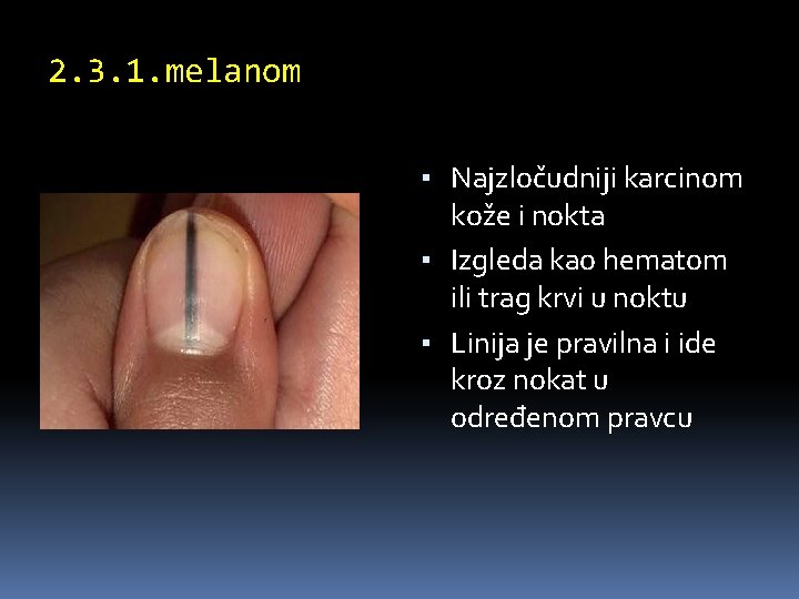 2. 3. 1. melanom ▪ Najzločudniji karcinom kože i nokta ▪ Izgleda kao hematom