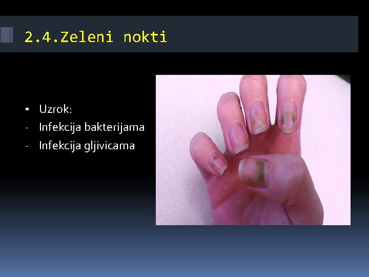  2. 4. Zeleni nokti ▪ Uzrok: - Infekcija bakterijama - Infekcija gljivicama 