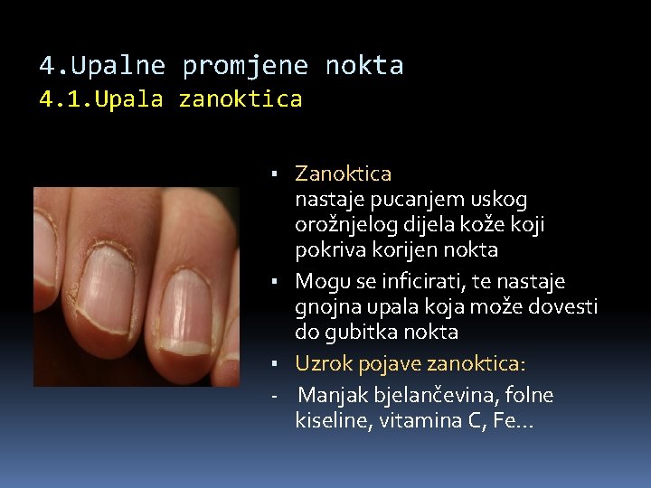 4. Upalne promjene nokta 4. 1. Upala zanoktica ▪ Zanoktica nastaje pucanjem uskog orožnjelog