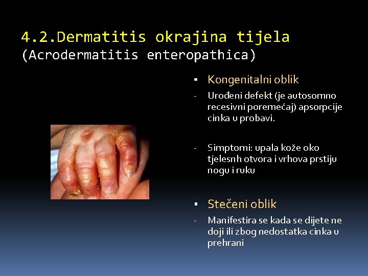 4. 2. Dermatitis okrajina tijela (Acrodermatitis enteropathica) ▪ Kongenitalni oblik - Urođeni defekt (je