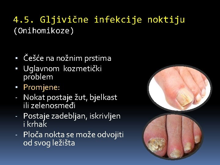 4. 5. Gljivične infekcije noktiju (Onihomikoze) ▪ Češće na nožnim prstima ▪ Uglavnom kozmetički