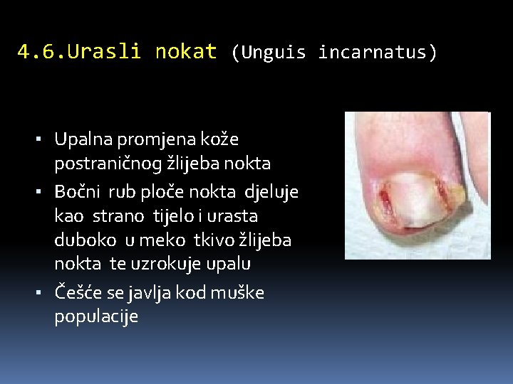 4. 6. Urasli nokat (Unguis incarnatus) ▪ Upalna promjena kože postraničnog žlijeba nokta ▪