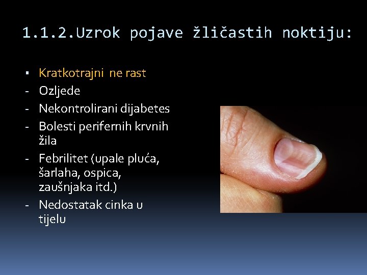 1. 1. 2. Uzrok pojave žličastih noktiju: Kratkotrajni ne rast Ozljede Nekontrolirani dijabetes Bolesti