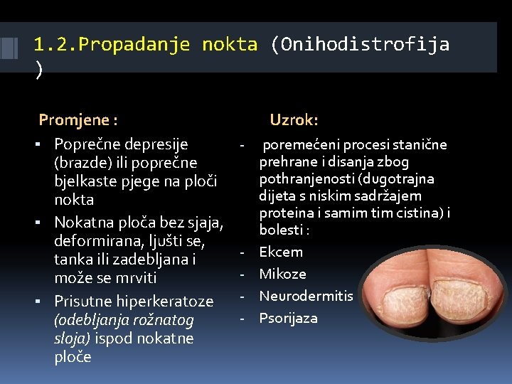 1. 2. Propadanje nokta (Onihodistrofija ) Promjene : ▪ Poprečne depresije (brazde) ili poprečne