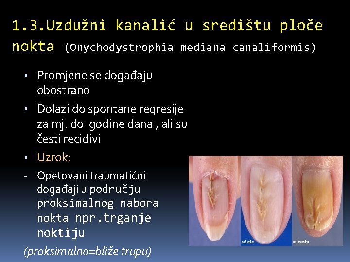 1. 3. Uzdužni kanalić u središtu ploče nokta (Onychodystrophia mediana canaliformis) ▪ Promjene se