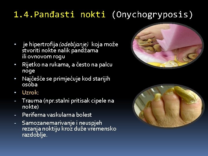 1. 4. Panđasti nokti (Onychogryposis) ▪ je hipertrofija (odebljanje) koja može ▪ ▪ ▪