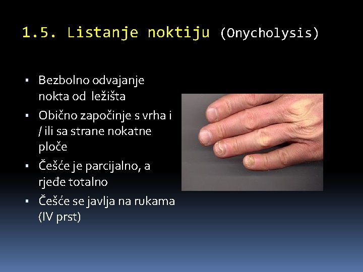 1. 5. Listanje noktiju (Onycholysis) ▪ Bezbolno odvajanje nokta od ležišta ▪ Obično započinje