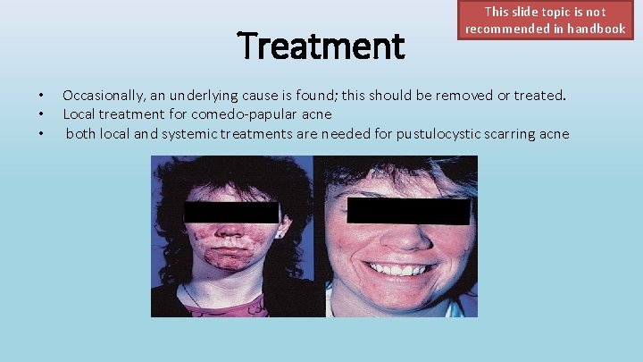 Treatment • • • This slide topic is not recommended in handbook Occasionally, an