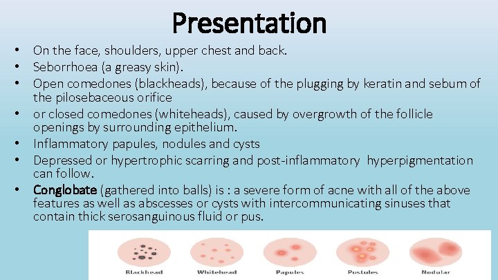 Presentation • On the face, shoulders, upper chest and back. • Seborrhoea (a greasy