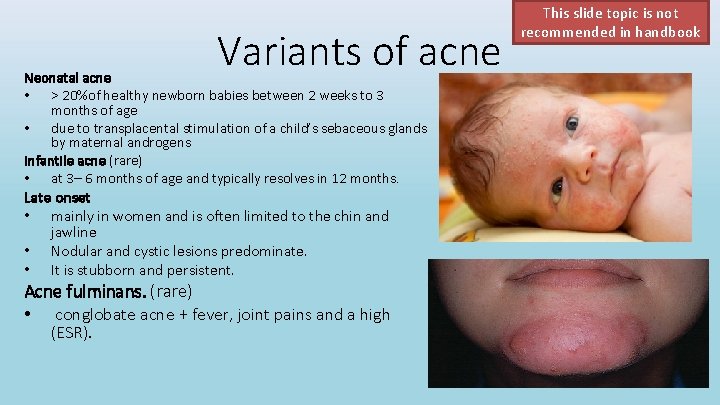 Variants of acne Neonatal acne • > 20%of healthy newborn babies between 2 weeks