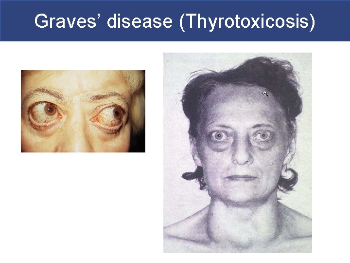 Graves’ disease (Thyrotoxicosis) 