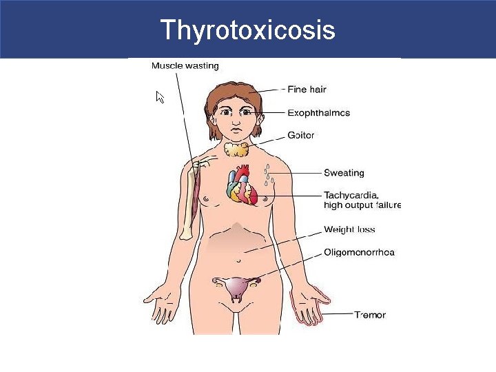 Thyrotoxicosis 