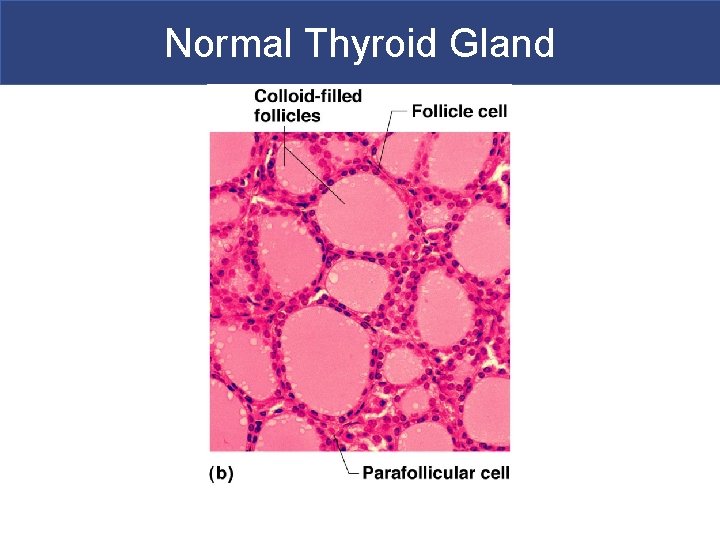 Normal Thyroid Gland 