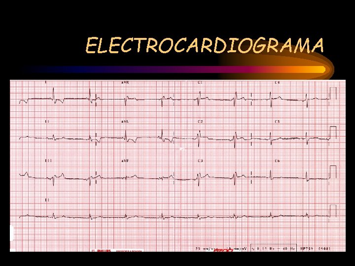 ELECTROCARDIOGRAMA 
