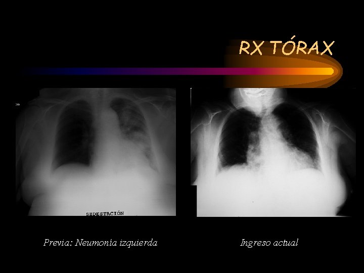 RX TÓRAX Previa: Neumonía izquierda Ingreso actual 