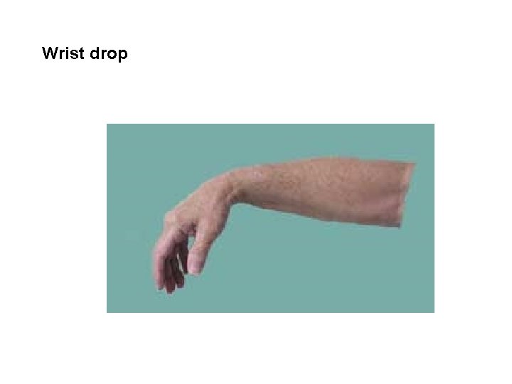 Wrist drop 