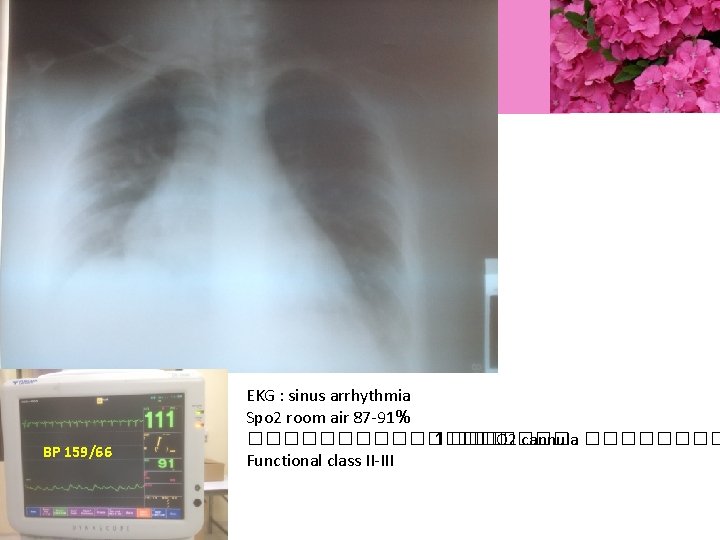 BP 159/66 EKG : sinus arrhythmia Spo 2 room air 87 -91% ��������� 1