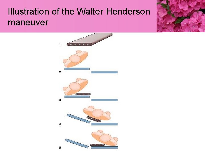 Illustration of the Walter Henderson maneuver 