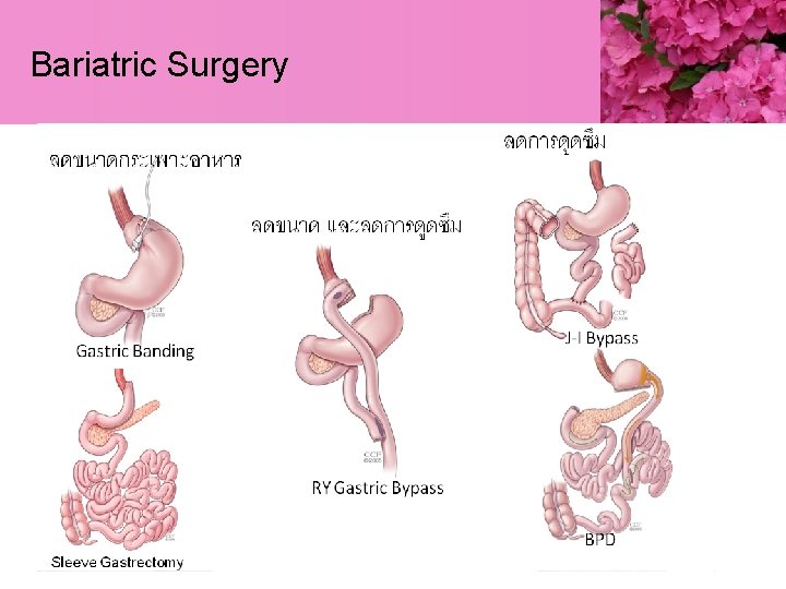 Bariatric Surgery 