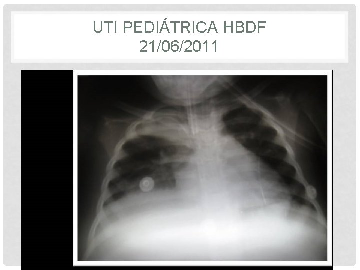 UTI PEDIÁTRICA HBDF 21/06/2011 