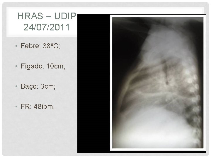 HRAS – UDIP 24/07/2011 • Febre: 38ºC; • Fígado: 10 cm; • Baço: 3