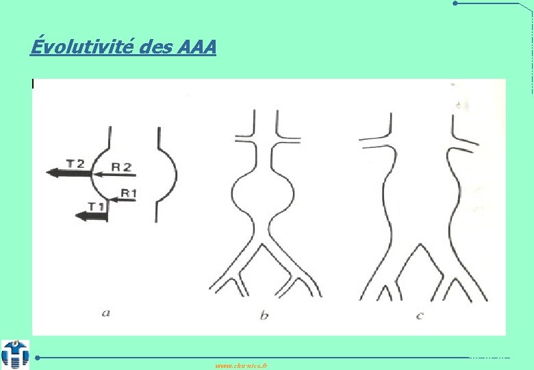 Évolutivité des AAA www. chu-nice. fr 