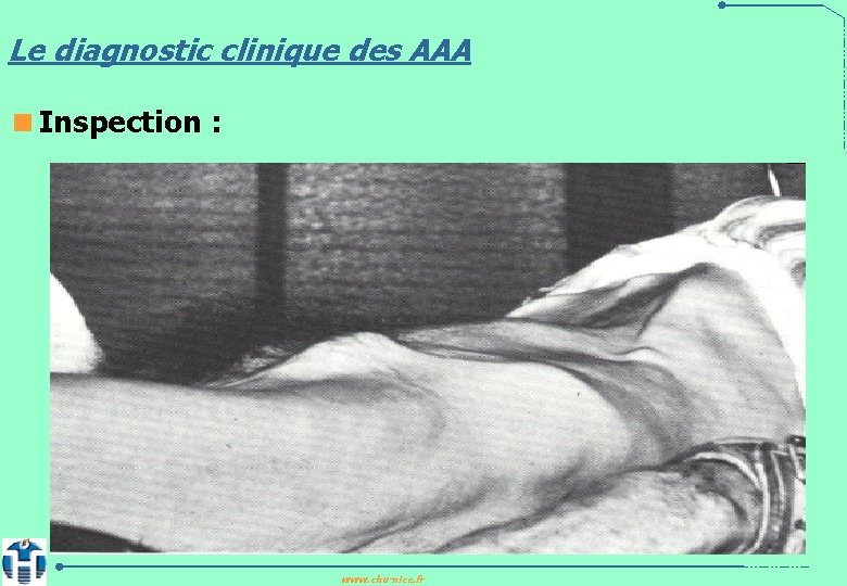 Le diagnostic clinique des AAA <Inspection : www. chu-nice. fr 