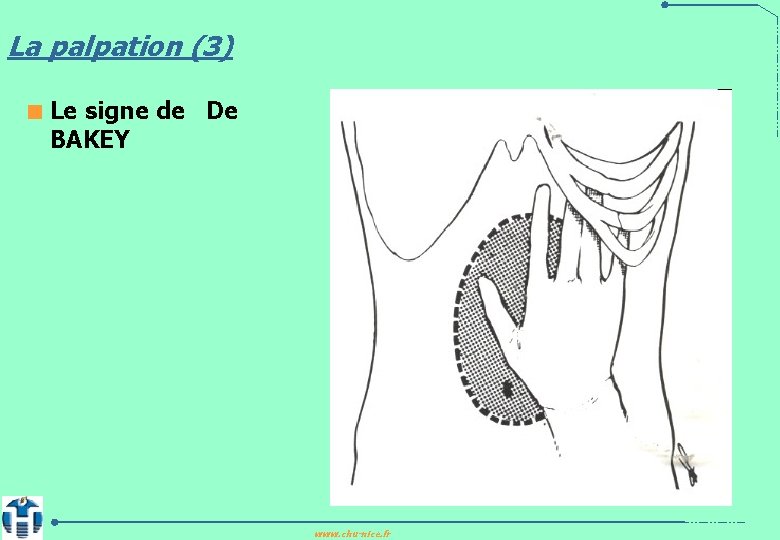 La palpation (3) < Le signe de De BAKEY www. chu-nice. fr 