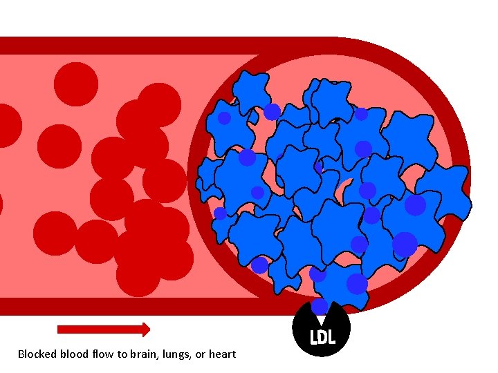 Blocked blood flow to brain, lungs, or heart 