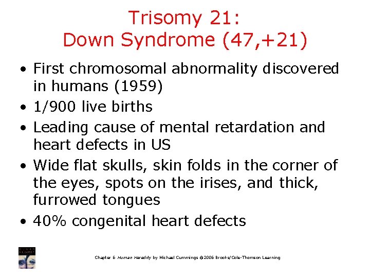 Trisomy 21: Down Syndrome (47, +21) • First chromosomal abnormality discovered in humans (1959)