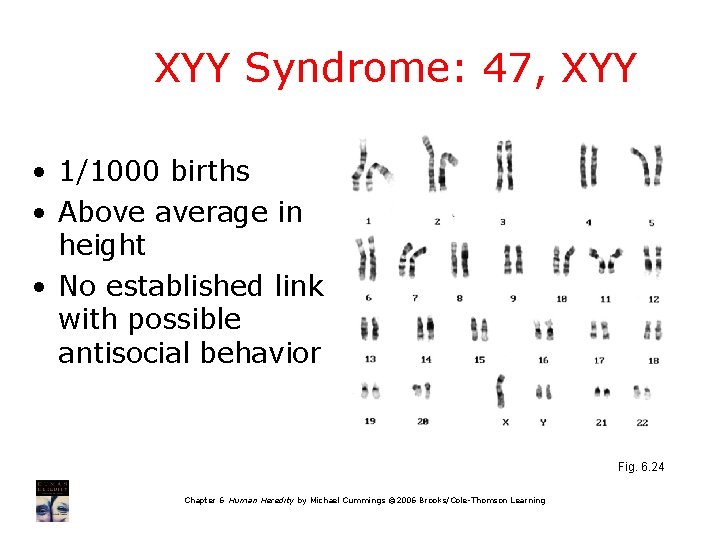 XYY Syndrome: 47, XYY • 1/1000 births • Above average in height • No