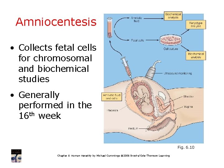 Amniocentesis • Collects fetal cells for chromosomal and biochemical studies • Generally performed in