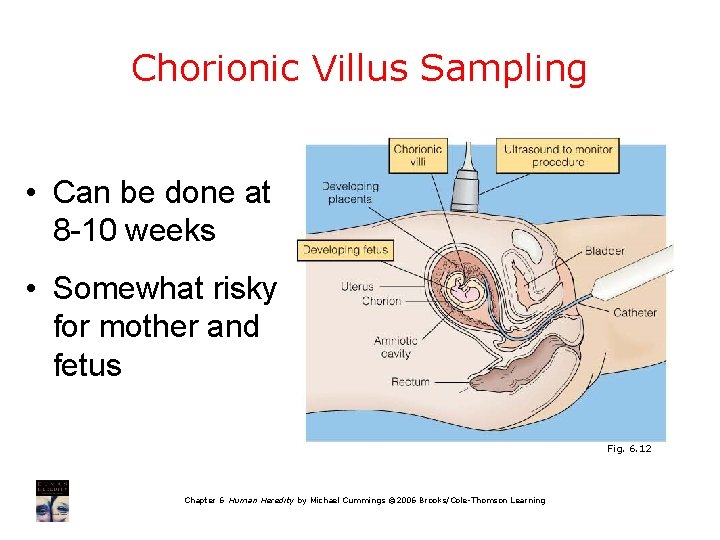 Chorionic Villus Sampling • Can be done at 8 -10 weeks • Somewhat risky