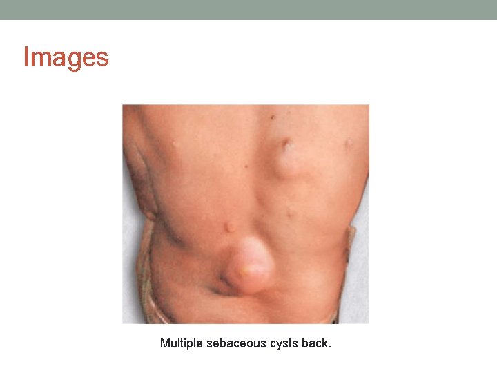 Images Multiple sebaceous cysts back. 