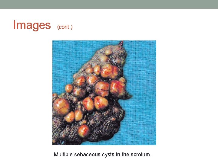 Images (cont. ) Multiple sebaceous cysts in the scrotum. 