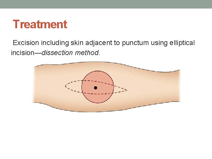 Treatment Excision including skin adjacent to punctum using elliptical incision—dissection method. 