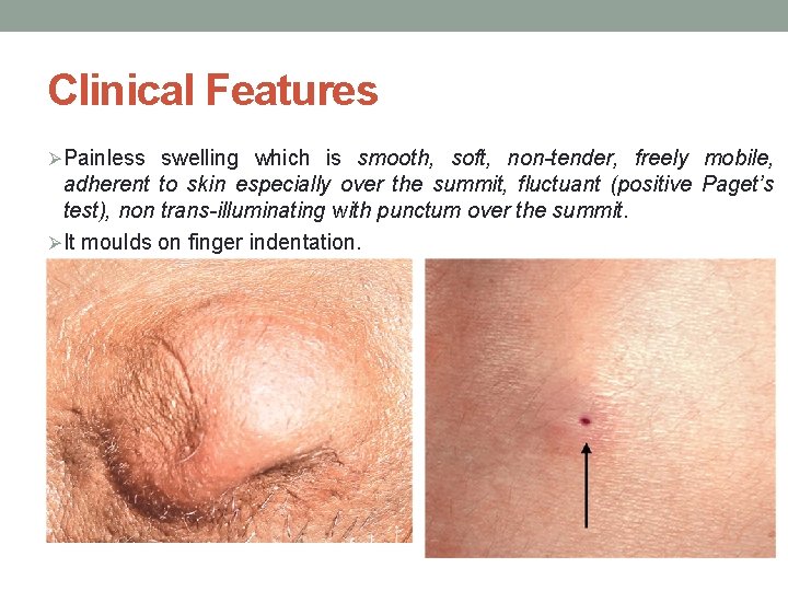 Clinical Features ØPainless swelling which is smooth, soft, non-tender, freely mobile, adherent to skin