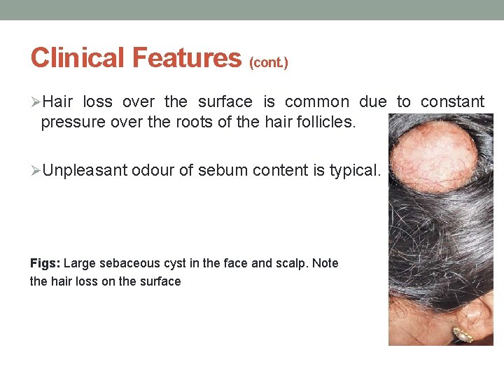 Clinical Features (cont. ) ØHair loss over the surface is common due to constant