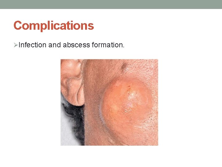 Complications ØInfection and abscess formation. 