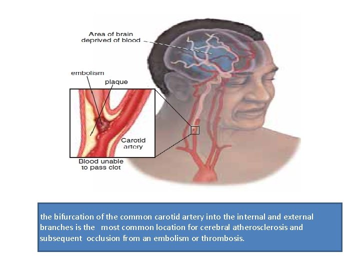 the bifurcation of the common carotid artery into the internal and external branches is