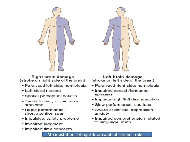 Manifestations of right-brain and left-brain stroke. 